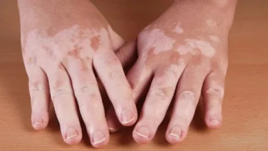 Photo of Hoy se conmemora el Día Mundial del Vitiligo