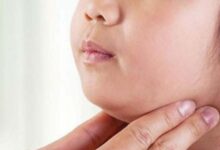 Photo of Salud reporta 27 casos confirmados de parotiditis