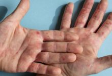 Photo of Mes para crear conciencia sobre el lupus y su impacto en la salud