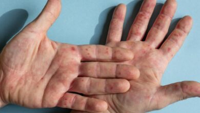 Photo of Mes para crear conciencia sobre el lupus y su impacto en la salud